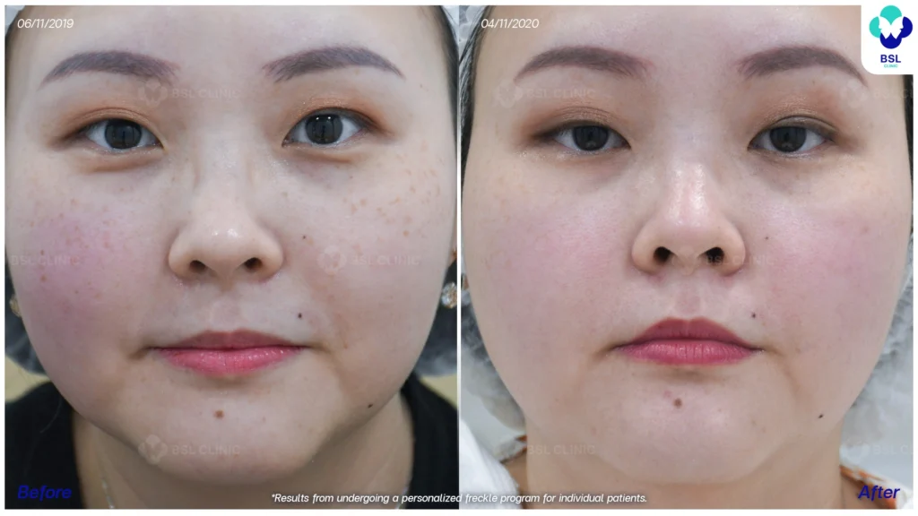 กระและสีผิวดูกลมกลืนขึ้น