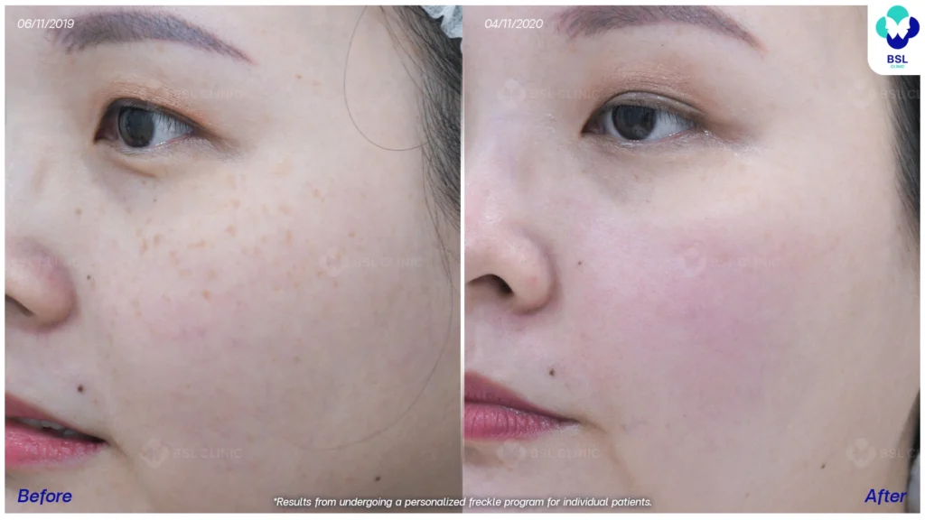 กระและสีผิวดูกลมกลืนขึ้น