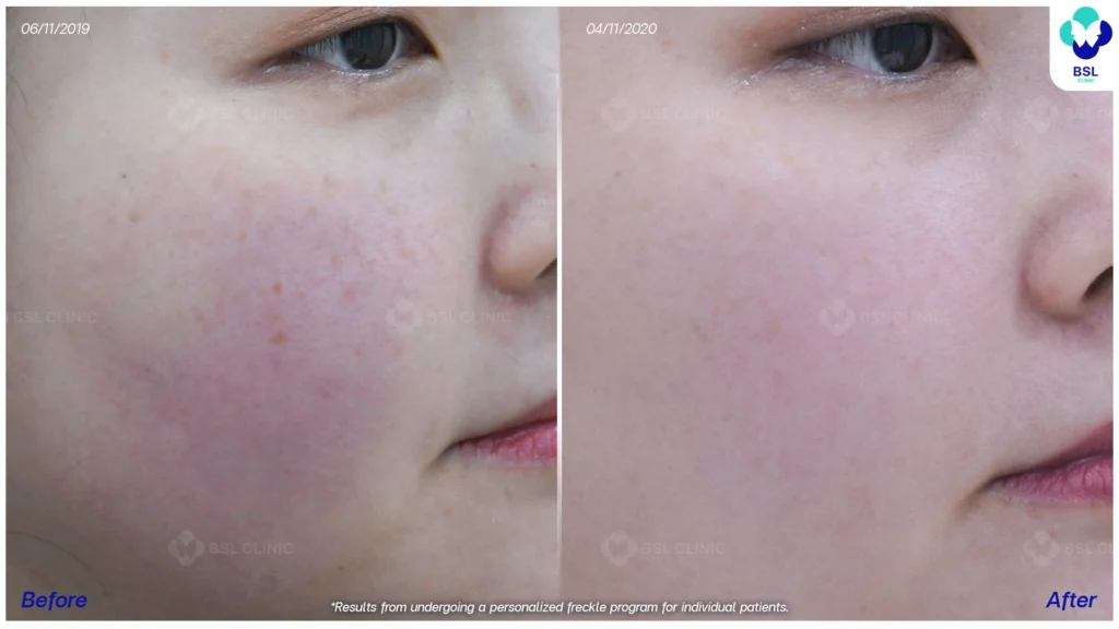 กระและสีผิวดูกลมกลืนขึ้น