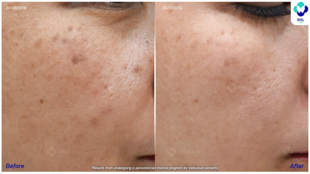 กระบริเวณใบหน้าก่อน–หลังโปรแกรมดูแลผิว