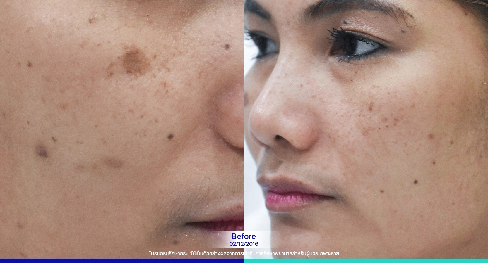 รีวิวรักษากระ