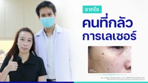รีวิวเลเซอร์กระตื้น