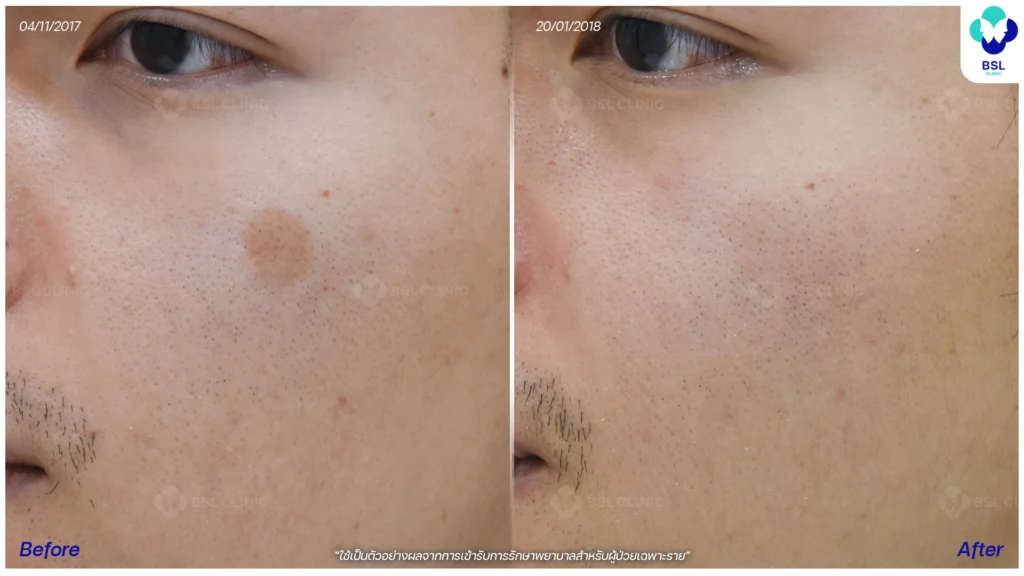 กระบริเวณใบหน้าก่อน–หลังโปรแกรมดูแลผิว