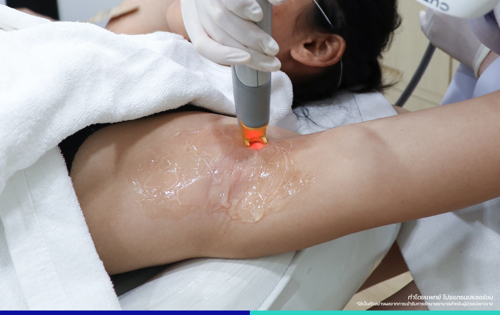 เลเซอร์ขนรักษแร้