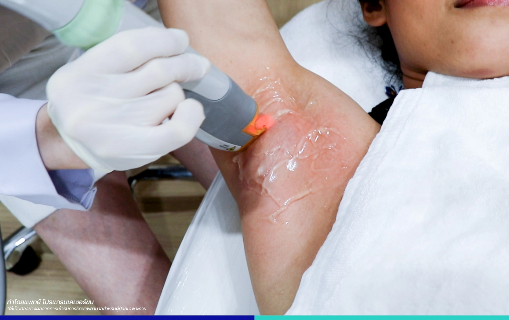 เลเซอร์ขนรักษแร้