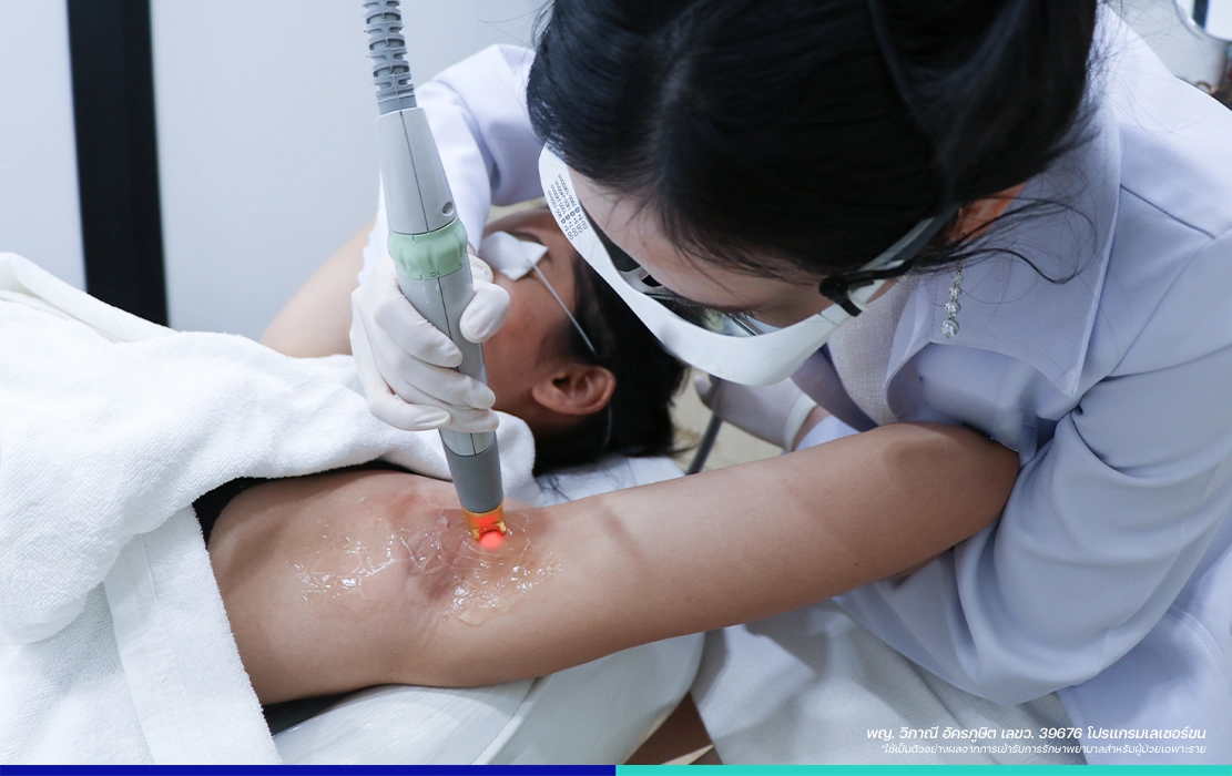 เลเซอร์ขนรักษแร้