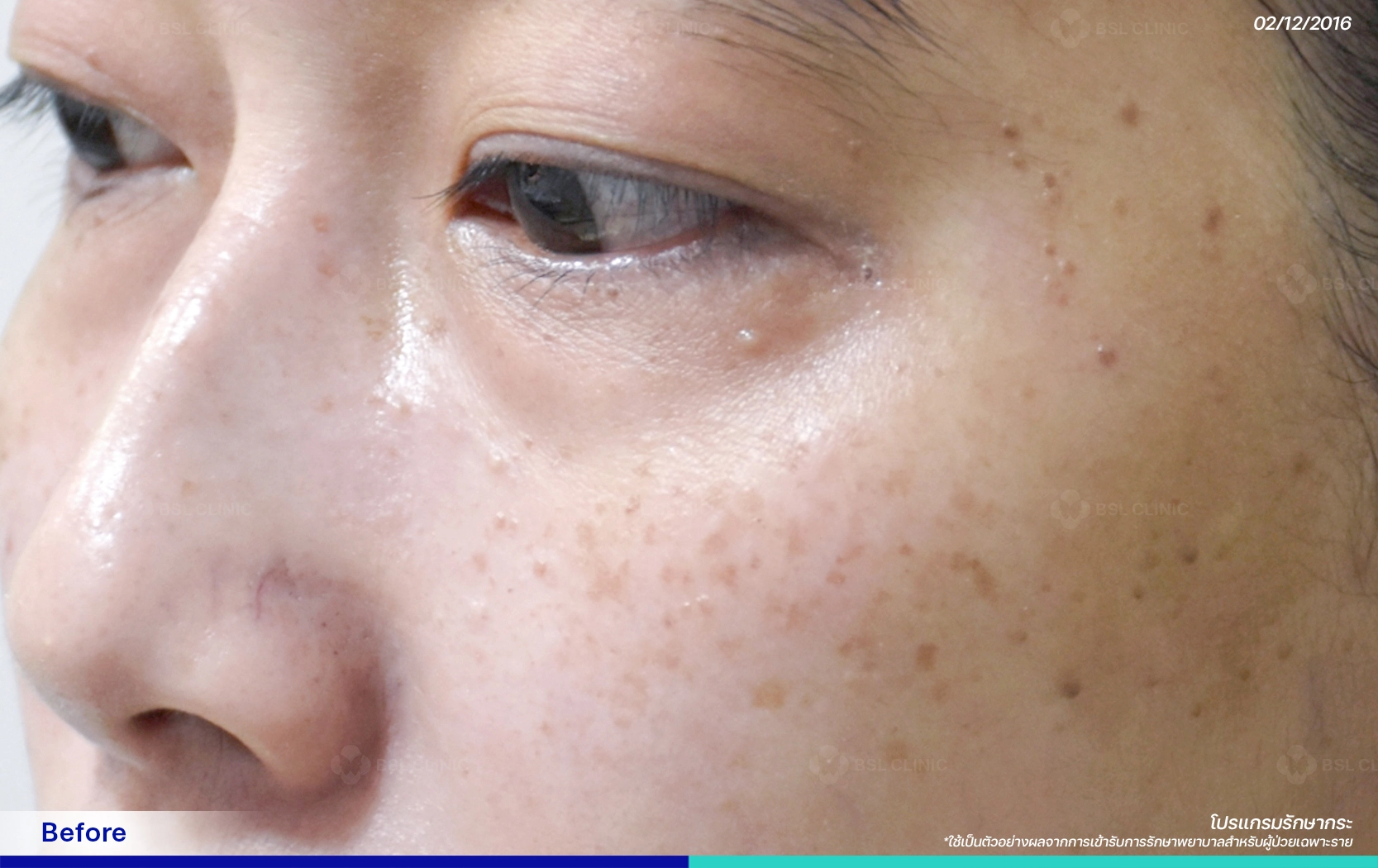 รีวิวเลเซอร์กระ