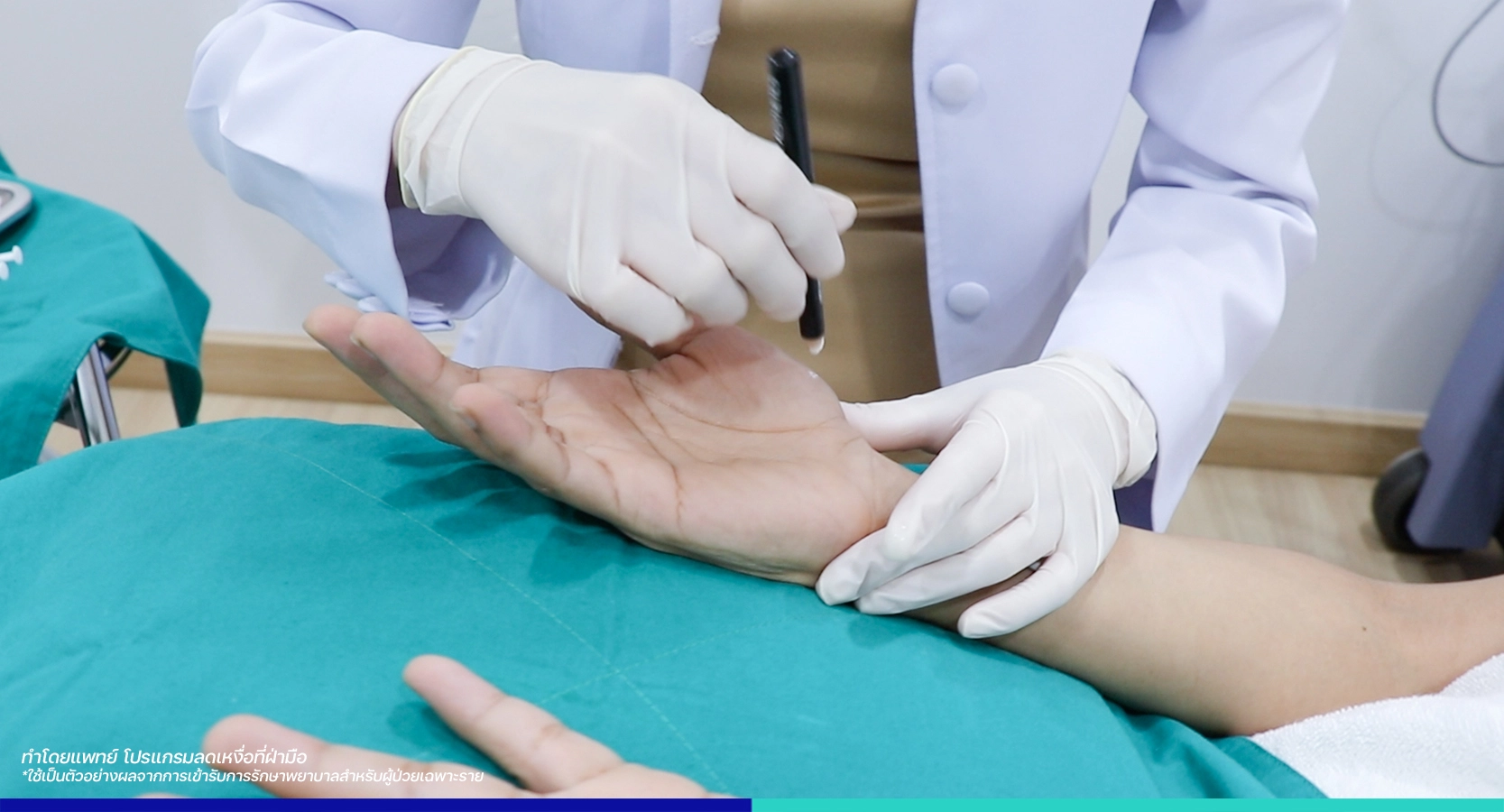 เหงื่อออกมากที่มือ