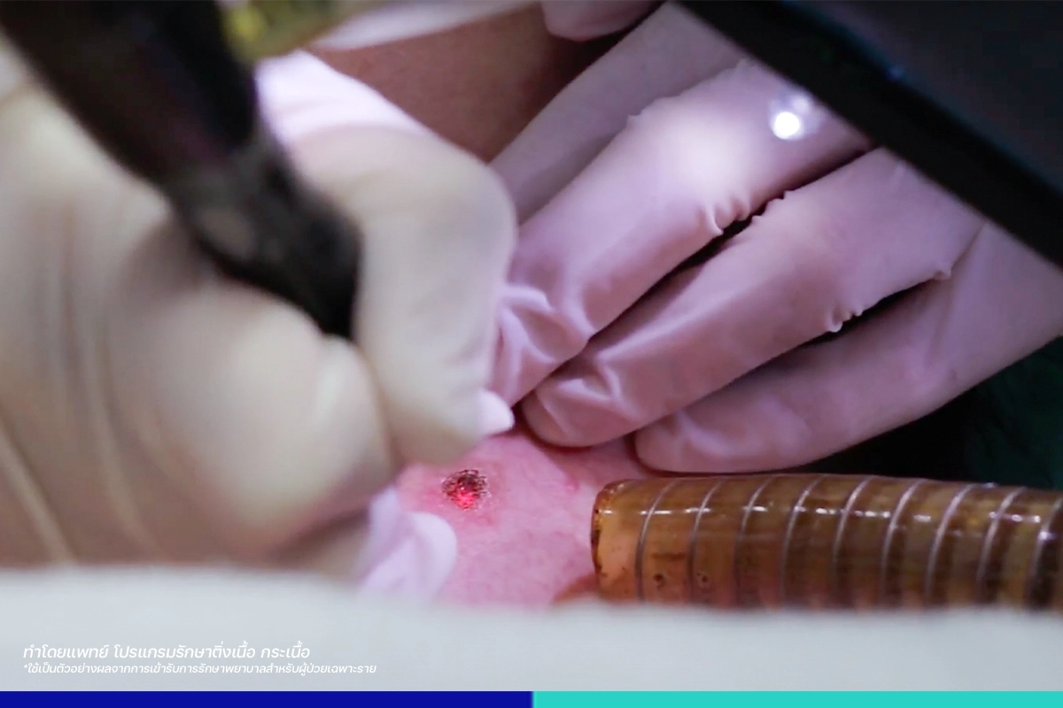 รักษาติ่งเนื้อ