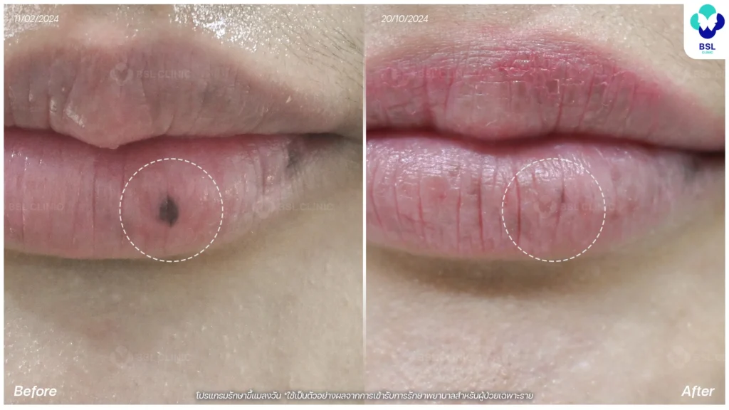 รีวิวรักษาขี้แมลงวันที่ปาก