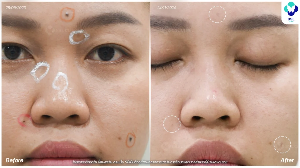 รีวิวรักษาขี้แมลงวัน