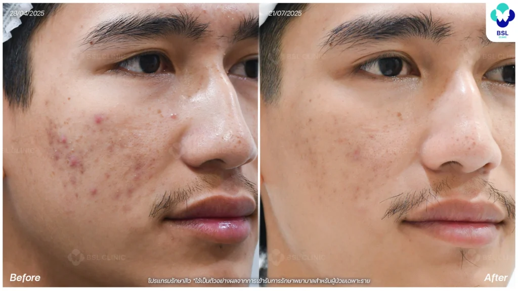 รักษาสิวหนุ่มใต้