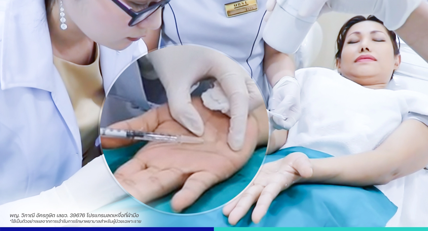 เหงื่อออกมากที่มือ