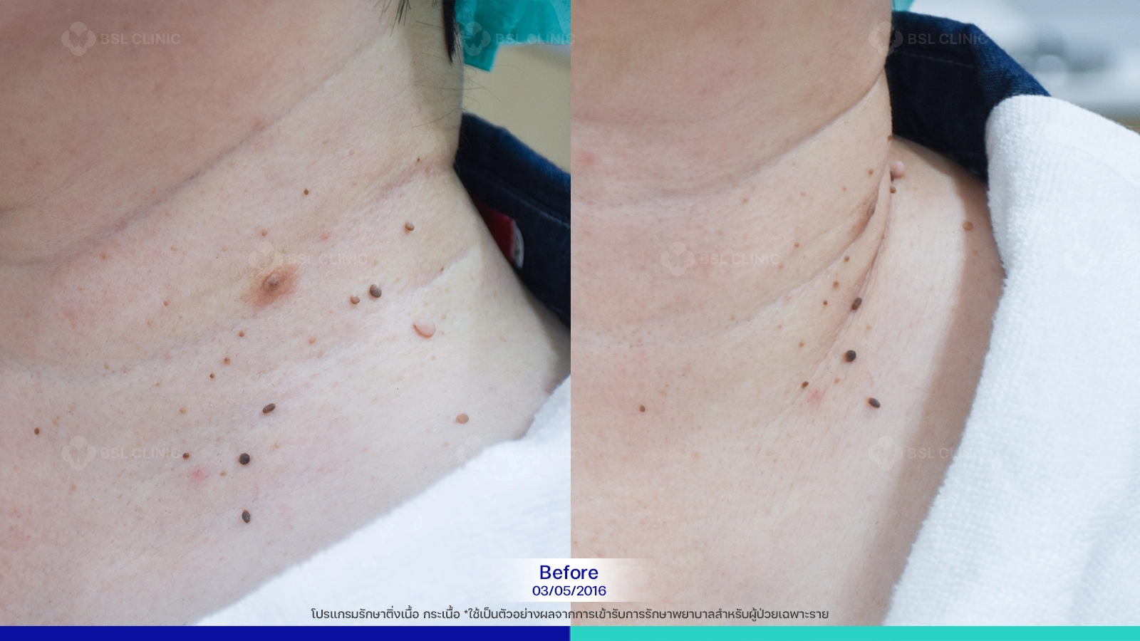 รีวิวเลเซอร์ติ่งเนื้อ