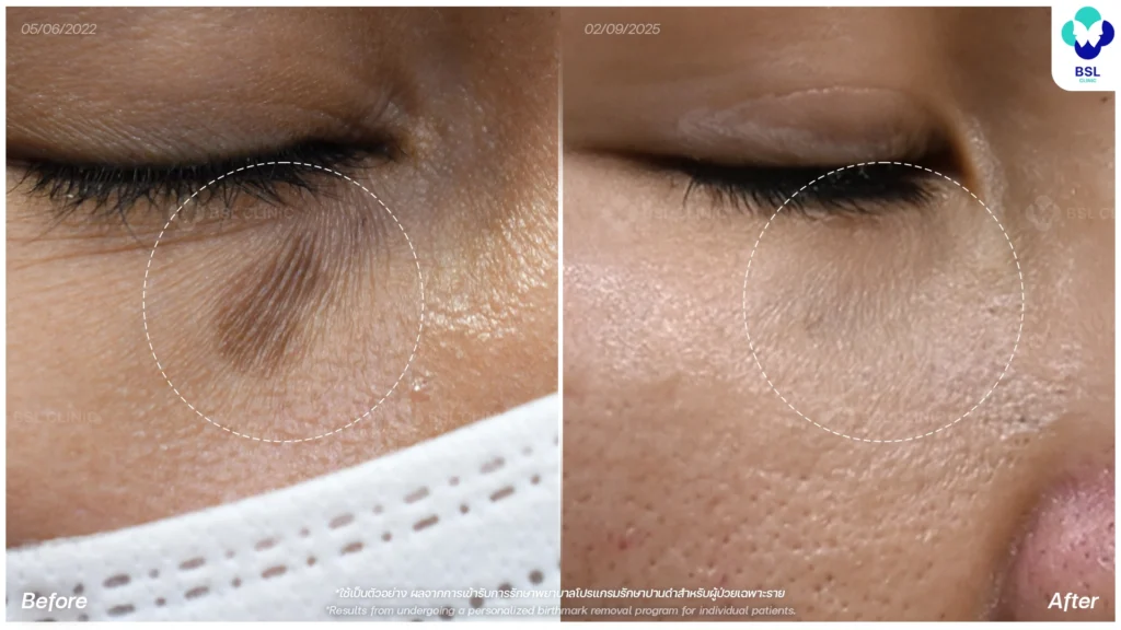 รีวิวรักษาปานดำ