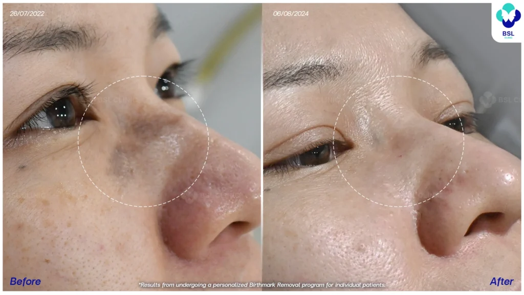 รีวิวรักษาปานดำ