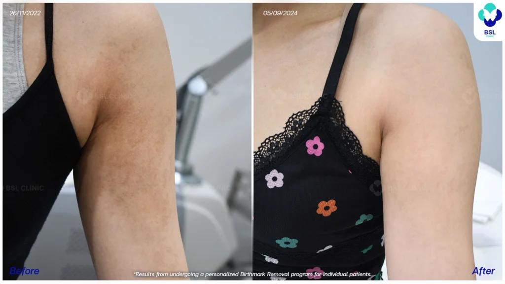 รีวิวรักษาปานดำ