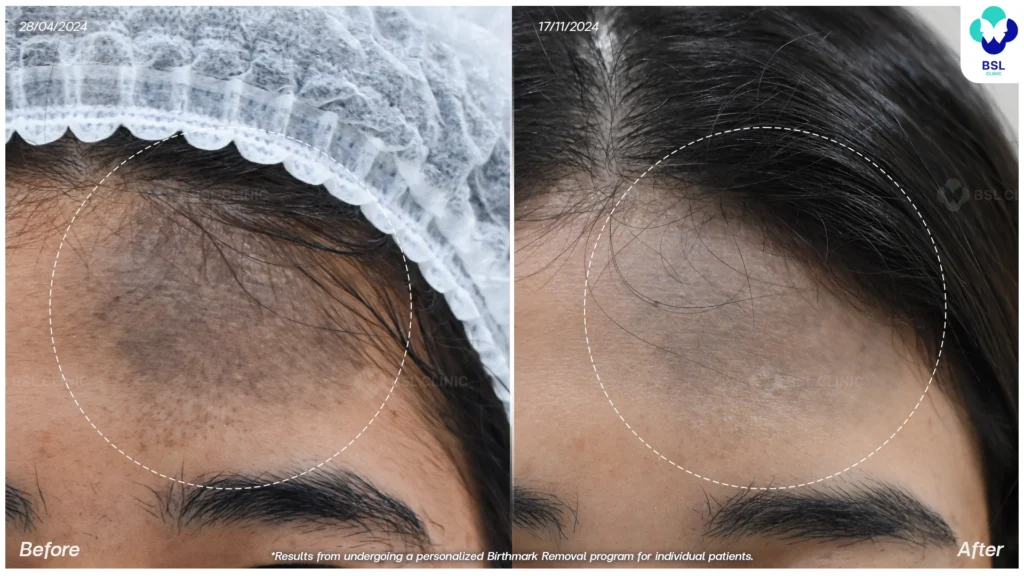 รีวิวรักษาปานดำบนหน้า