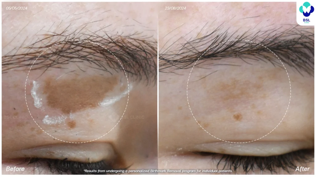 รีวิวรักษารอยแดง