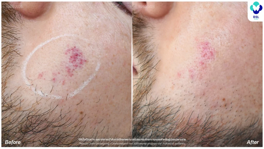 รีวิวรักษาปานแดง