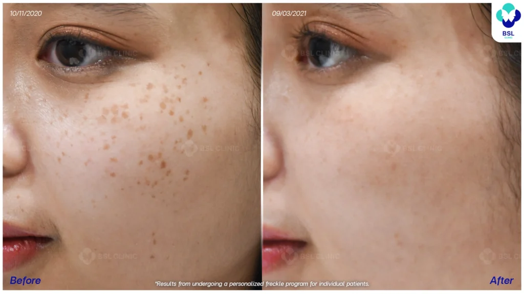 เคสกระในผู้รับบริการจริง