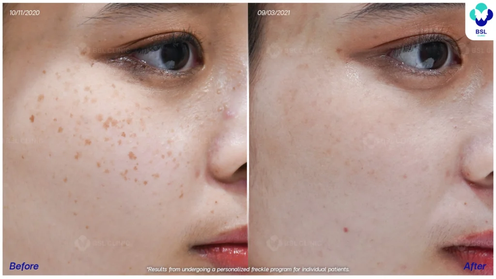 เคสกระในผู้รับบริการจริง