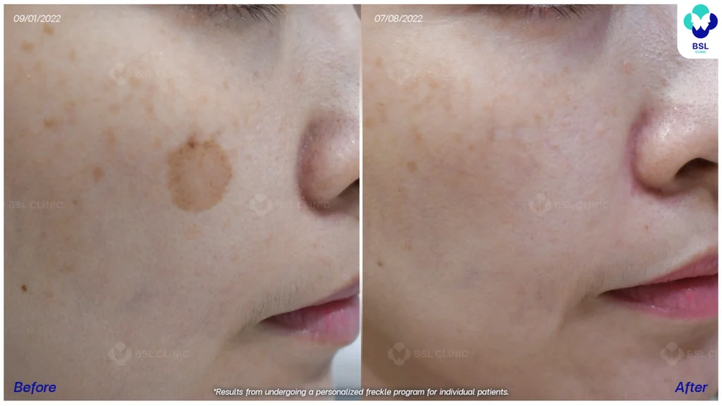 กระบริเวณใบหน้าก่อน–หลังโปรแกรมดูแลผิว