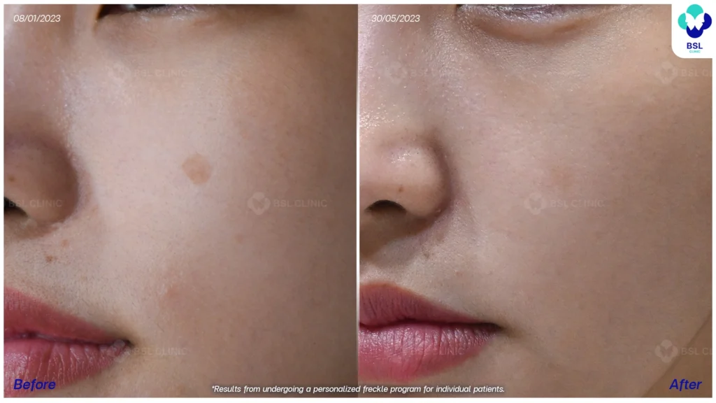 กระบริเวณใบหน้าก่อน–หลังโปรแกรมดูแลผิว