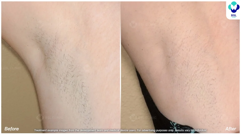 รีวิวเลเซอร์ขน