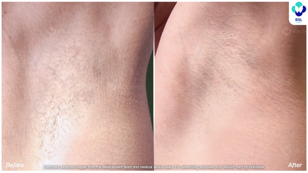 รีวิวเลเซอร์ขน