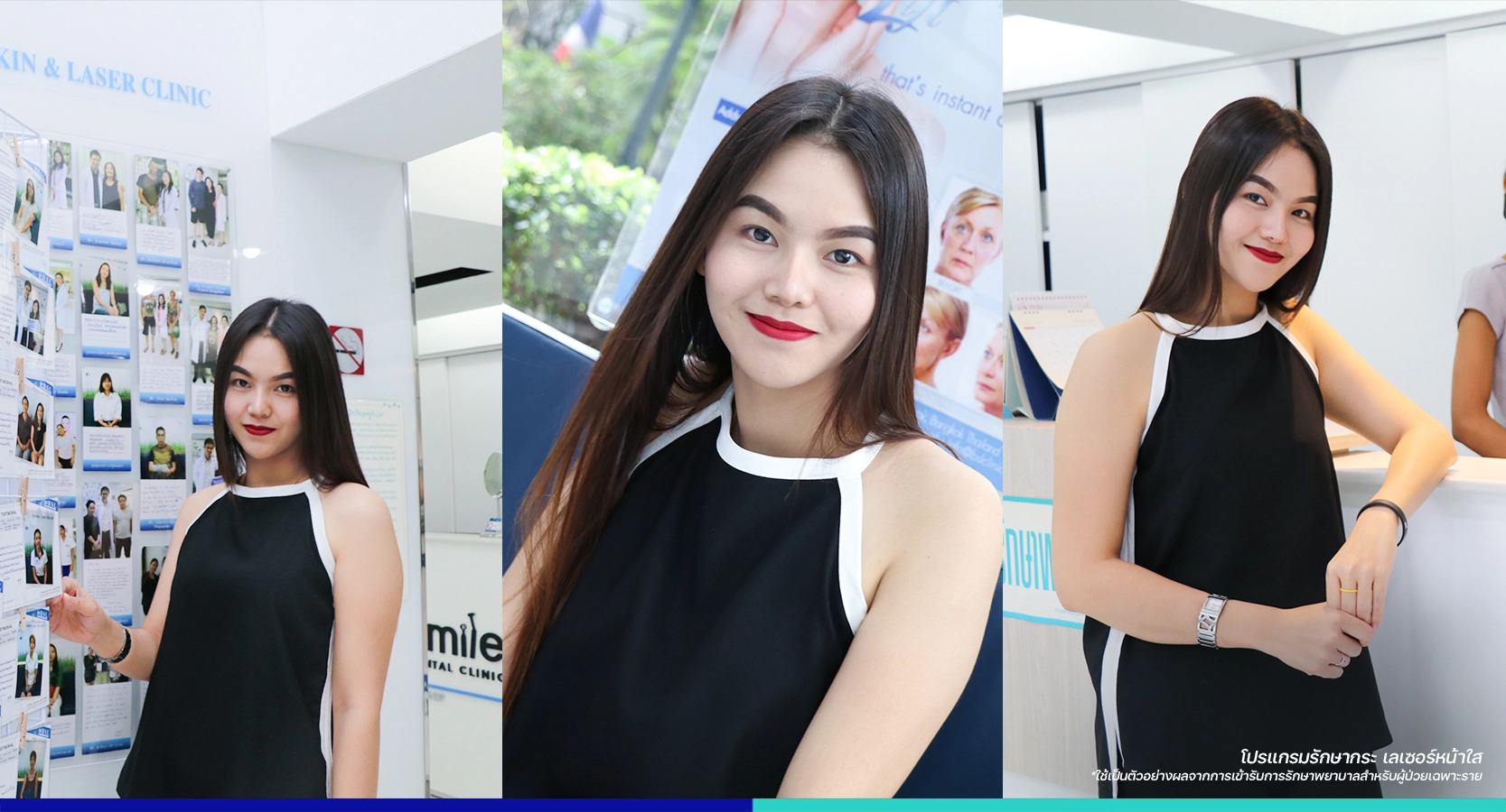 เลเซอร์หน้าใส