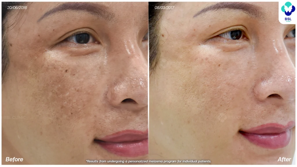 รีวิวรักษาฝ้า