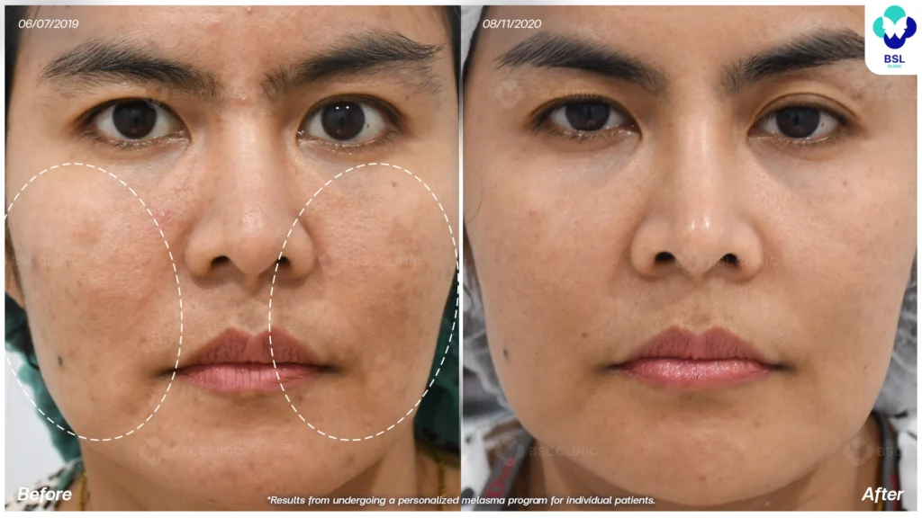 ผลลัพธ์หลังดูแลฝ้า