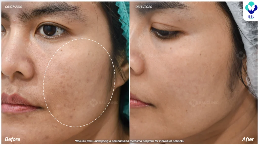 ผลลัพธ์หลังดูแลฝ้า