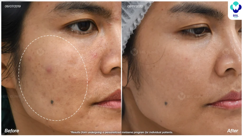 ผลลัพธ์หลังดูแลฝ้า