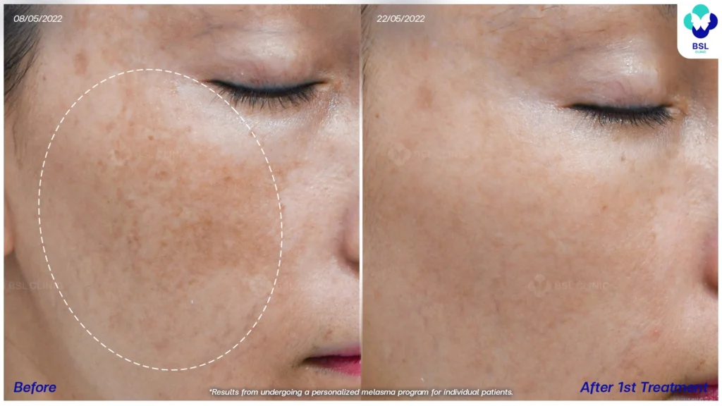 เคสฝ้าในกลุ่มวัยทำงาน