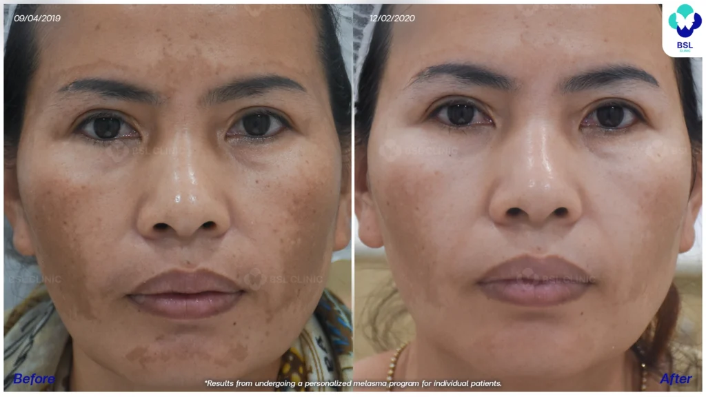 ผลลัพธ์หลังดูแลฝ้า