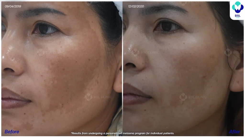 ผลลัพธ์หลังดูแลฝ้า