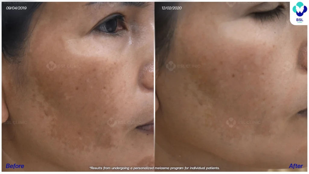 ผลลัพธ์หลังดูแลฝ้า