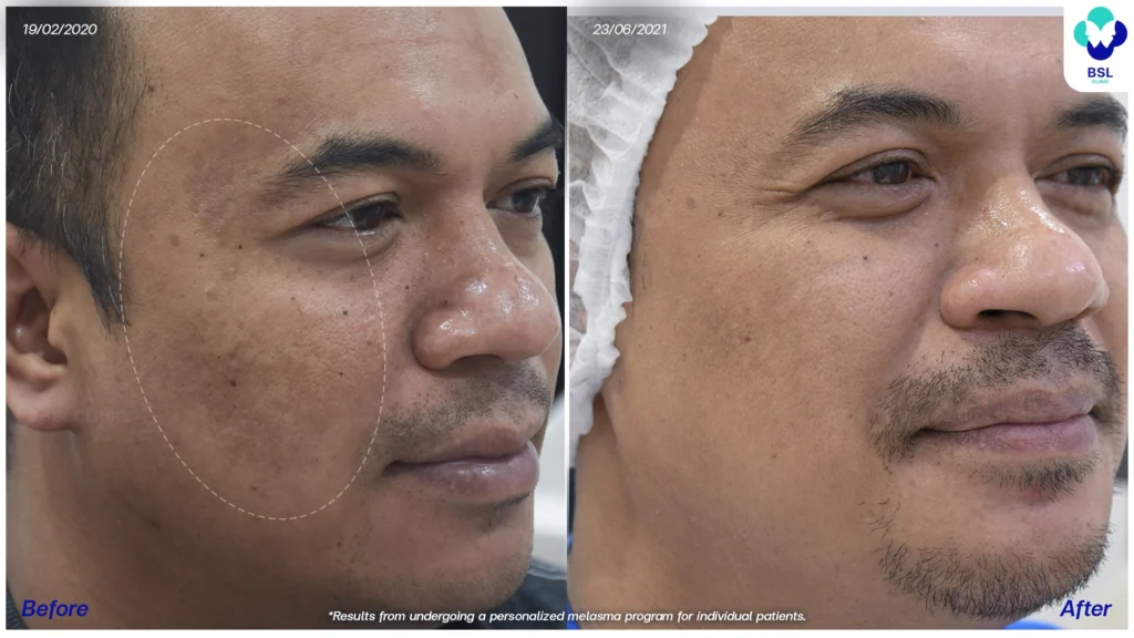 เคสฝ้าและจุดด่างดำบนใบหน้า