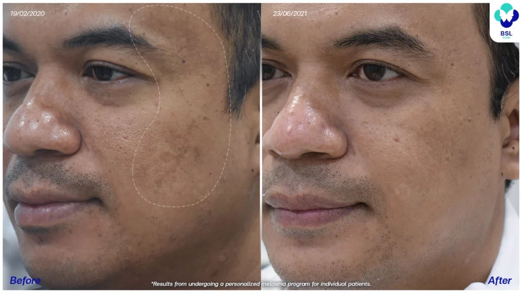 เคสฝ้าและจุดด่างดำบนใบหน้า