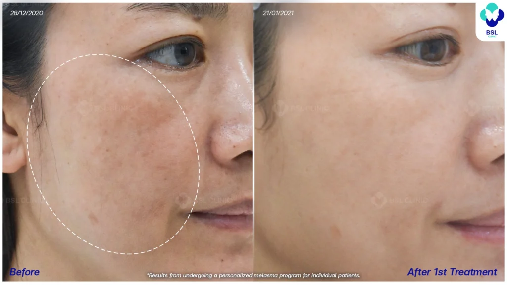 เคสฝ้าในกลุ่มวัยทำงาน