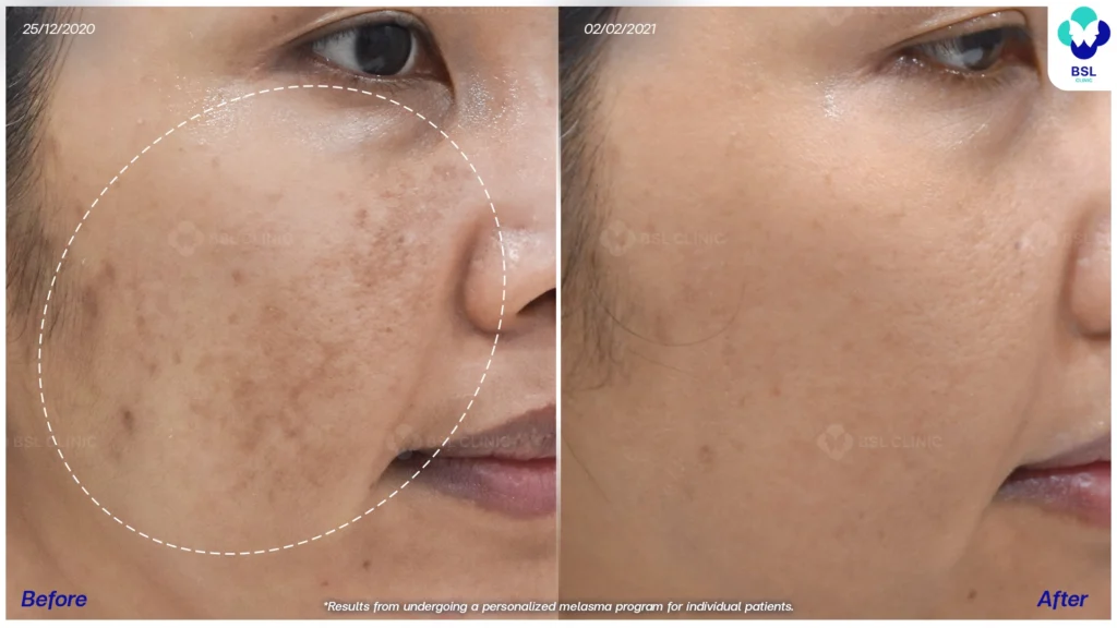 เคสฝ้าในกลุ่มวัยทำงาน