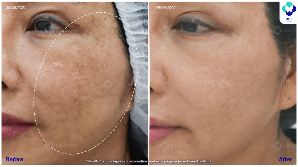 ดูแลปัญหาฝ้ากับ BSL Clinic