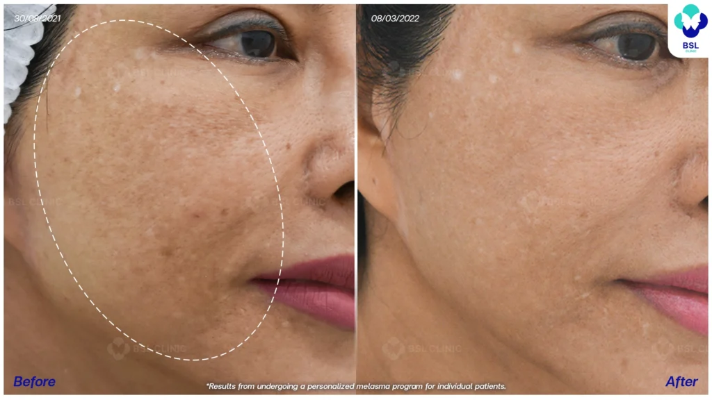 ดูแลปัญหาฝ้ากับ BSL Clinic