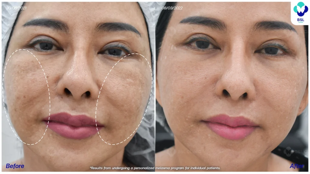 ดูแลปัญหาฝ้ากับ BSL Clinic