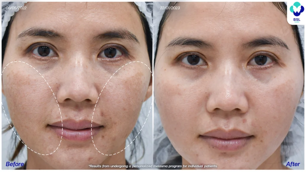 ดูแลปัญหาฝ้ากับ BSL Clinic