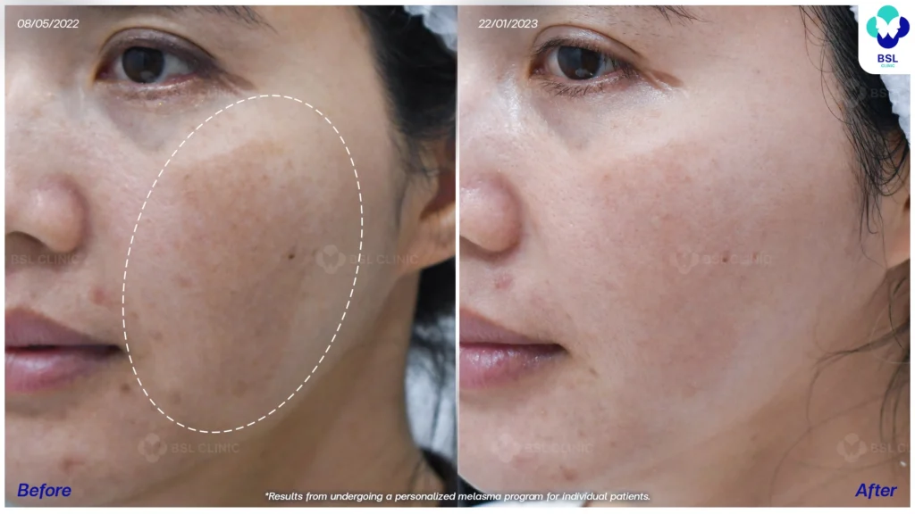 รีวิวรักษาฝ้า