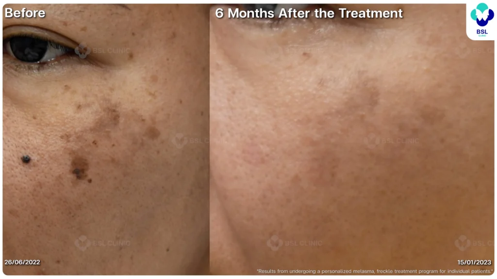 เคสฝ้าและจุดด่างดำบนใบหน้า