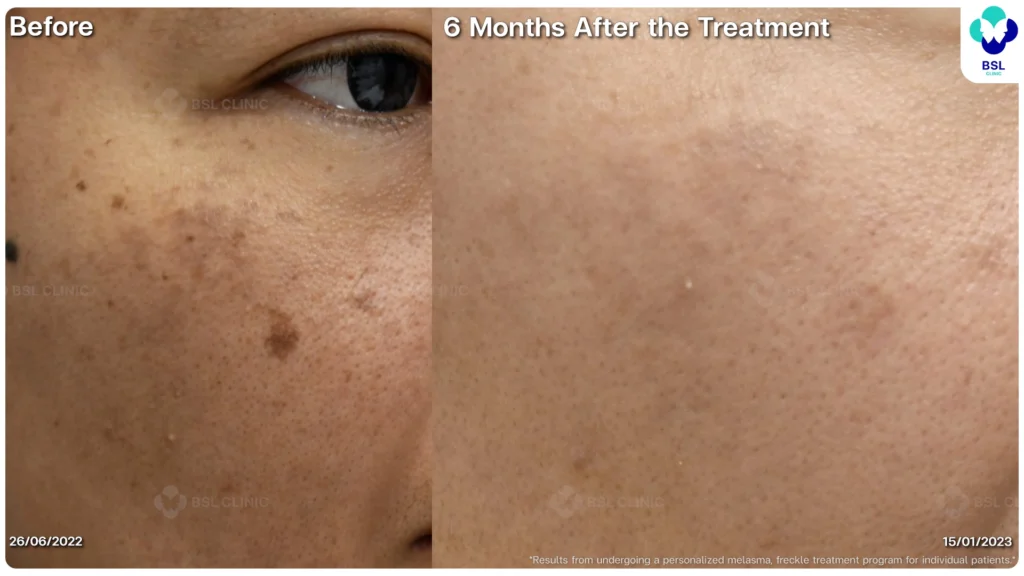 เคสฝ้าและจุดด่างดำบนใบหน้า